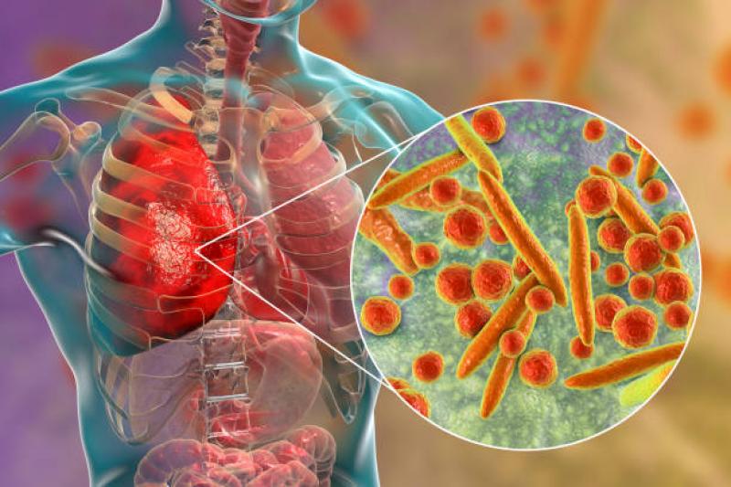 Foto blog Anak Usia Sekolah Rentan Terkena Mycoplasma Pneumonia, Ini Gejala dan Cara Pengobatannya