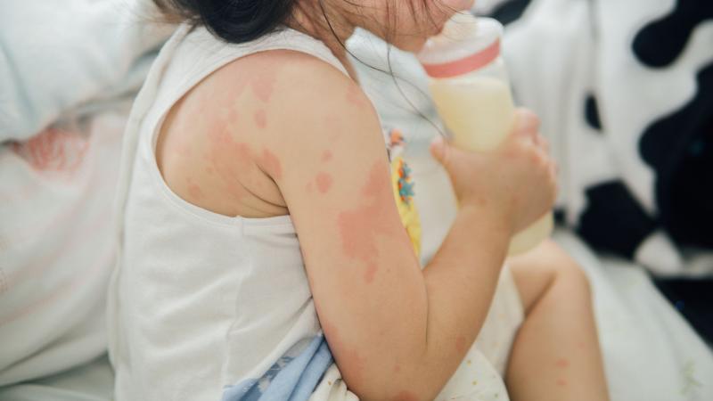 Foto blog Mengenal & Menangani Alergi pada Anak
